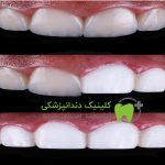 تا چند ساعت بعد از کامپوزیت نباید چیزی خورد؟ هشدارهای مهم قبل از خوردن غذا بعد از کامپوزیت