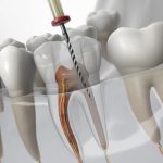 راهنمای کامل انتخاب سایز و طول مناسب فایل روتاری