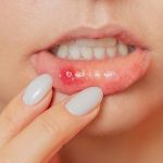 تفاوت آفت دهان و زگیل دهان چیست؟