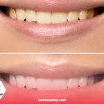 تفاوت خمیردندان سفید کننده و معمولی